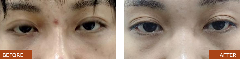 Eye Filler Before and After Treatment Images